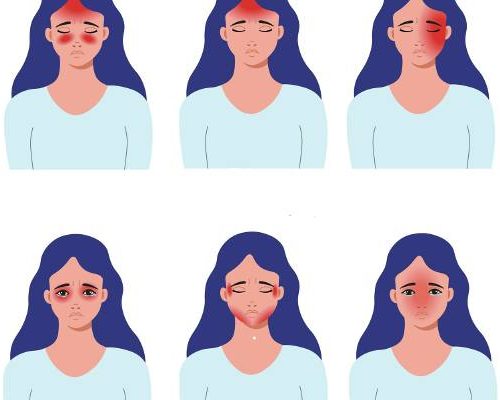 Mapa bólu głowy. Co oznacza ból głowy w danym miejscu? Naucz się rozpoznawać rodzaje bólu głowy po ich umiejscowieniu