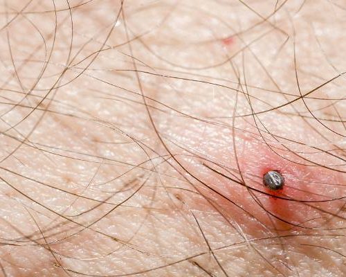 Rumień po kleszczu – alergia czy borelioza? Sprawdź, kiedy zaczerwienienie powinno niepokoić