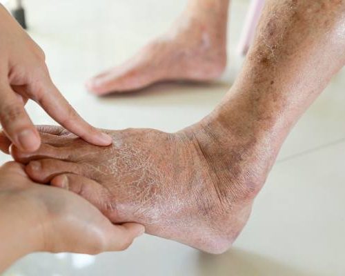 Objawy choroby Alzheimera widoczne na stopach. Po tych zmianach poznasz, że rozwija się demencja