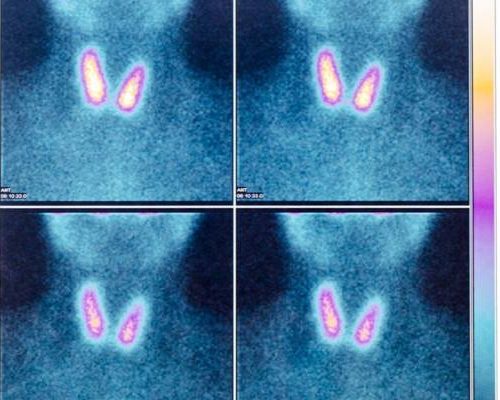 Scyntygrafia – jak działają izotopy promieniotwórcze, jakie są rodzaje i wskazania do wykonania scyntygrafii?