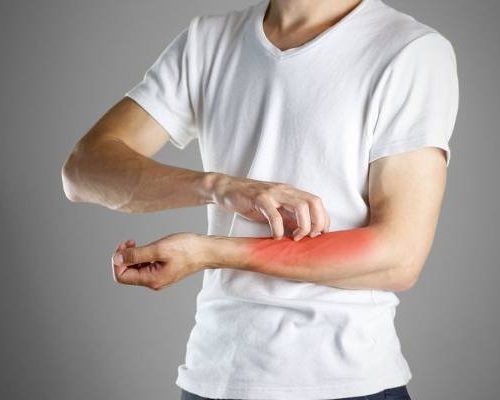 Świerzb ludzki – drogi zakażenia, przyczyny, objawy, diagnostyka i leczenie. Jak można zakazić się świerzbowcem?