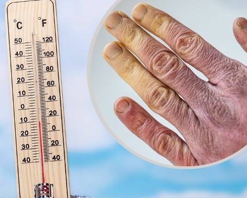 Nie trzeba siarczystych mrozów, by nabawić się odmrożeń. Na początku nawet ich nie czuć