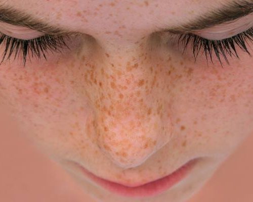 Jak powstają piegi? Najlepsze sposoby na usuwanie piegów na twarzy i zapobieganie ich powstawaniu